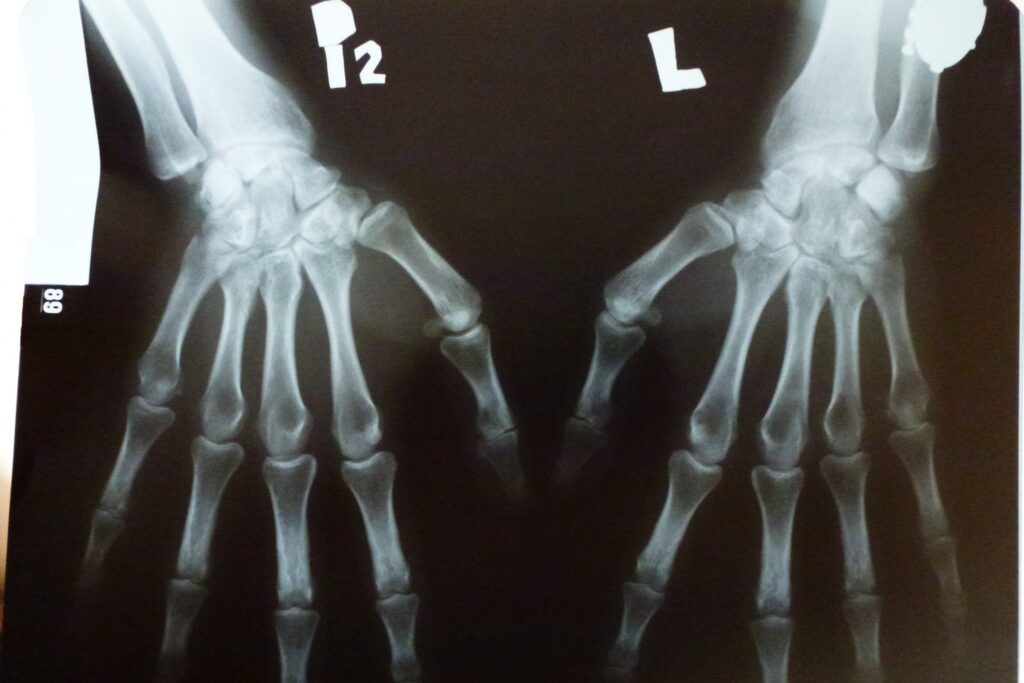 Dłonie na zdjęciu rentgenowskim
