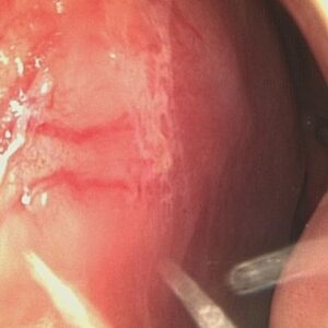 Poszerzone naczynia w śluzówce przedniego odcinka przegrody nosowej widziane w powiększeniu w trakcie endoskopii nosa