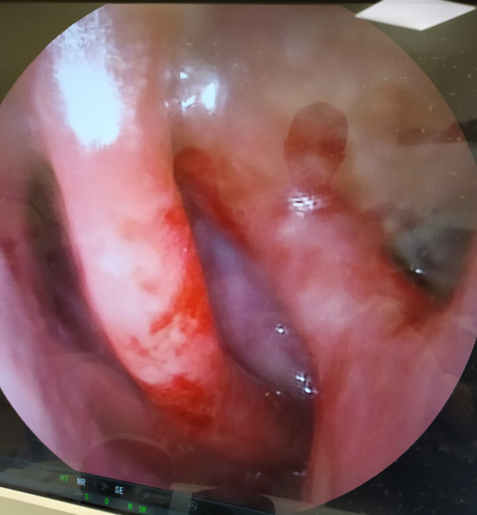 Aktywne krwawienie z błony śluzowej nosa u chorego z mukowiscydozą widoczne podczas nasofiberoskopii